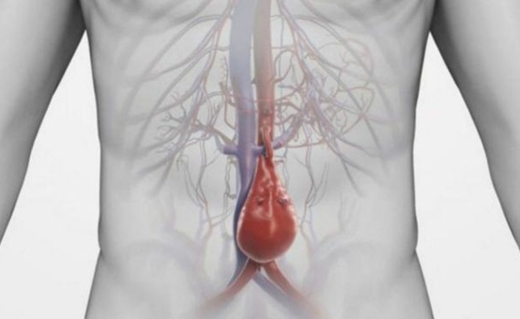 فحص تمدد الأوعية الدموية أنقذ حياة الآلاف في بريطانيا