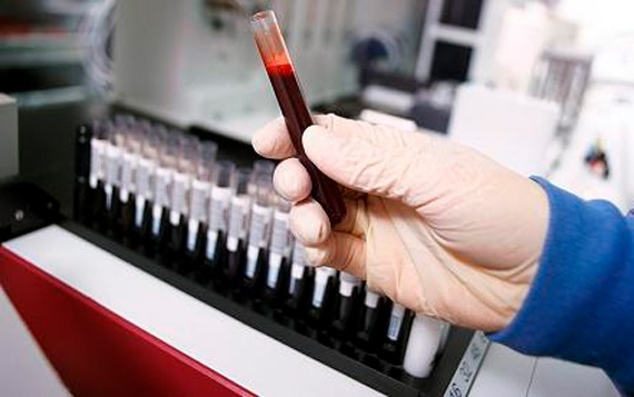 شركة طبية تريد رصد السرطان من خلال اختبارات الدم