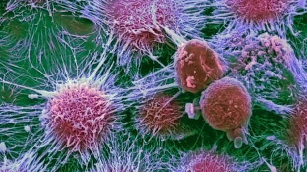 ثلاث شقيقات يدعمن مشروعا بريطانيا لتطوير بديل للعلاج الكيميائي للسرطان