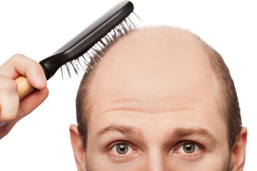 تطوير خلايا جلدية مخبريا يمنح الأمل في علاج تساقط الشعر