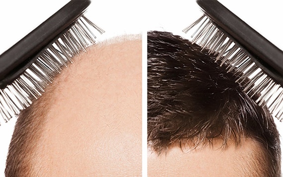 زراعة الشعر تجعل الرجل يبدو أكثر جاذبية وأصغر سنا
