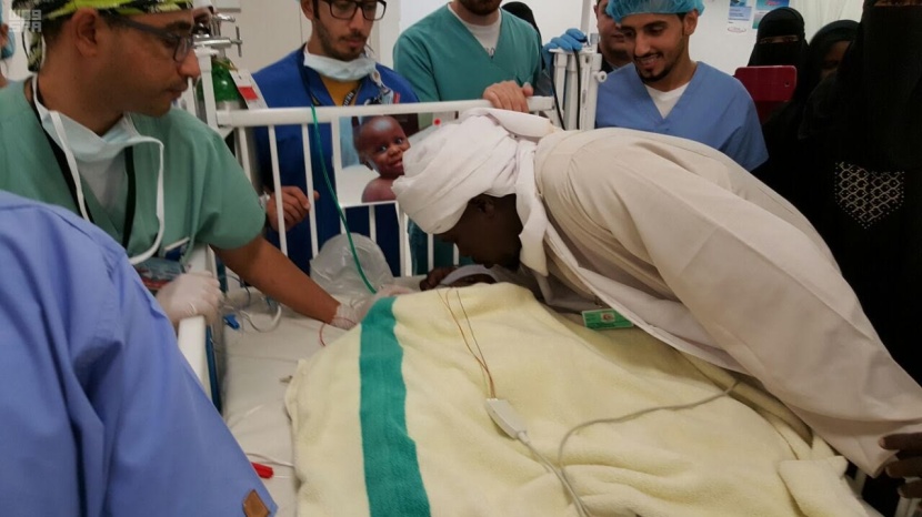 نجاح عملية فصل التوأم السوداني "رماح ووضاح"