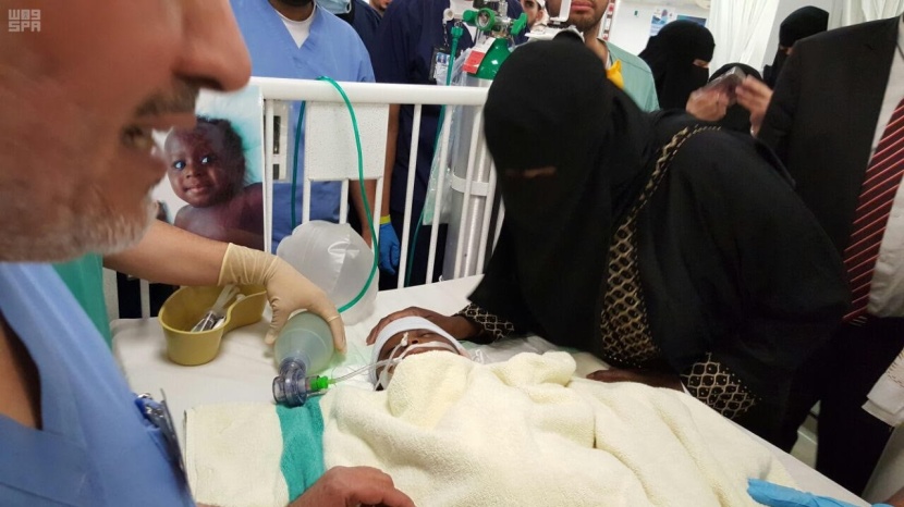 نجاح عملية فصل التوأم السوداني "رماح ووضاح"