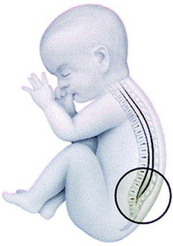 الصلب المشقوق .. 3 أسباب للمرض و5 أعراض تصيب الأطفال