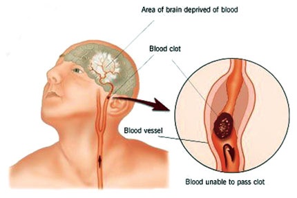 جلطة المخ .. 3 ساعات حاسمة وكل دقيقة تأخير تدمر مليوني خلية عصبية