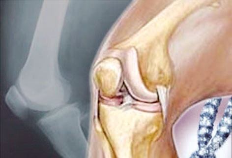 هشاشة العظام .. هؤلاء معرضون!