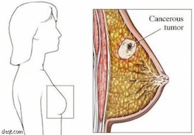 سرطان الثدي في السعودية .. 800 حالة سنويا و50 % تكتشف متأخرة