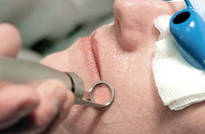 الليزر أحدث التقنيات الحديثة في إزالة الشعر وعلاج الندبات والبشرة الداكنة