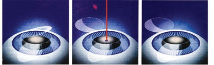 الإنتراليزك .. دون مشرط .. دون ألم .. وبأمان تام