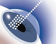 الإنتراليزك .. دون مشرط .. دون ألم .. وبأمان تام