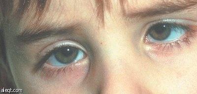 علاج الحول في سن مبكرة يضمن نتائج أكثر فاعلية