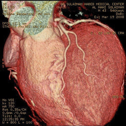 جهاز CARDIAC CT SCAN الأحدث لاكتشاف الجلطات الرئوية والقلبية مبكرا
