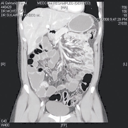 جهاز CARDIAC CT – SCAN يكتشف الجلطات الرئوية والقلبية مبكرا