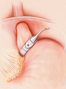 عملية تحزيم المعدة بالمنظار تتم ببساطة ودون أي قطع أو تدبيس