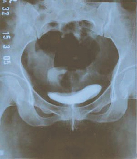 استخدام الأشعة الصوتية مهم للتشخيص ولمشاهدة أي تغيرات تطرأ على المجرى البولي