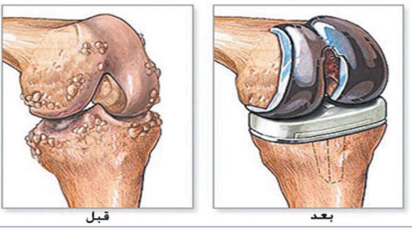 كفاءات عالمية لإجراء عمليات المفاصل الصناعية بمهارة ودقة متناهية