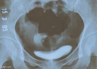 في مثل هذا اليوم .. صحيفة ألمانية تعلن ان وليام رونتغن اكتشف الاشعة السينية