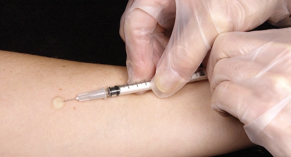 سلالات من «السل» لا يمكن علاجها بالأدوية