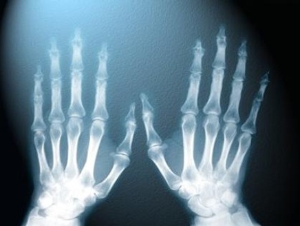 في مثل هذا اليوم ..  اكتشاف الأشعة السينية