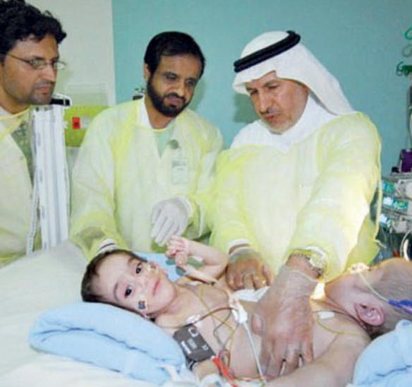 نجاح عملية فصل التوأم السيامي اليمني