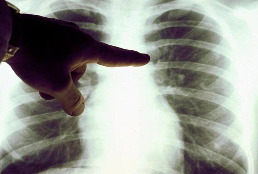 نظام الذكاء الاصطناعي لـ «جوجل» يحسن من اكتشاف سرطان الثدي