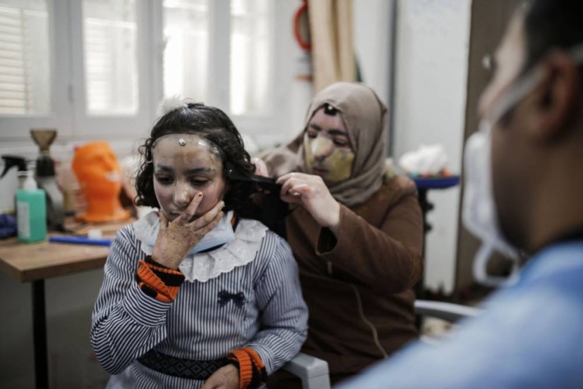 أقنعة ثلاثية الأبعاد تمنح الأمل لضحايا حروق الوجه