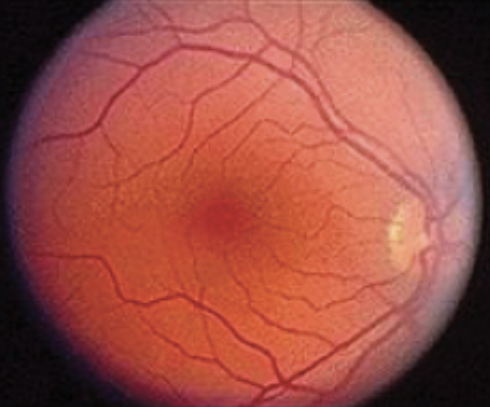 ما علاقة شبكية العين بإصابة النوبة القلبية؟