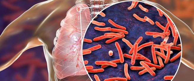 «السل» .. مرض قاتل لا يحظى باهتمام كاف