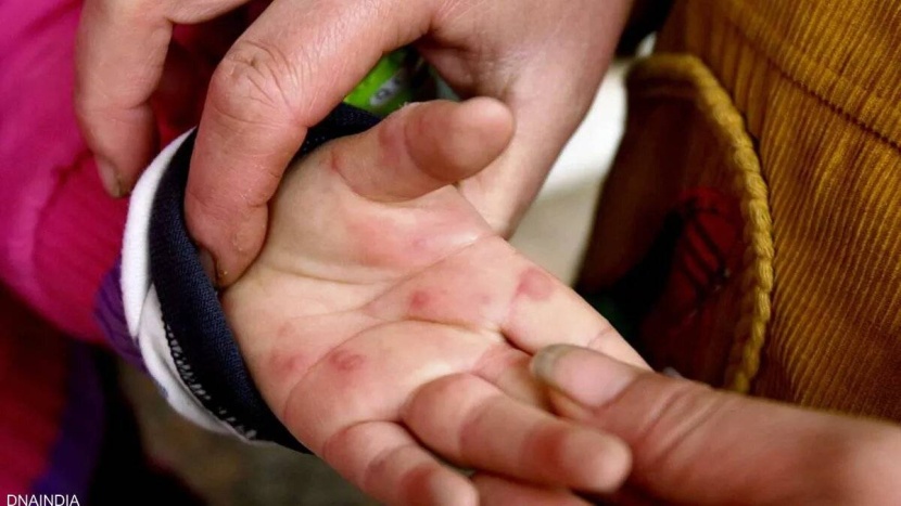 "إنفلونزا الطماطم".. مرض جديد ينتشر بين الأطفال في الهند