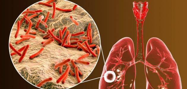 علاج جديد ينهي مرض السل المقاوم للأدوية