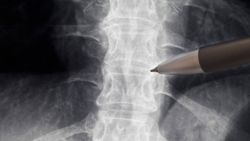 طريقة مبتكرة تصلح الألياف التالفة في العمود الفقري