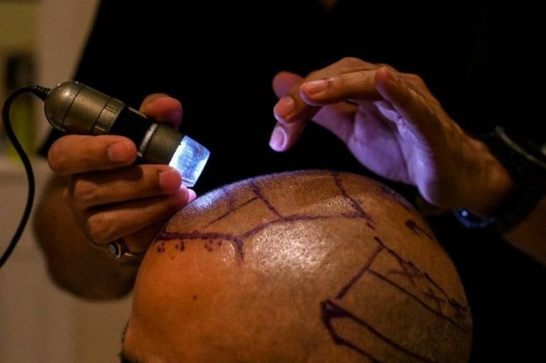 عملية زراعة الشعر قد تكون قاتلة بسبب الهواة