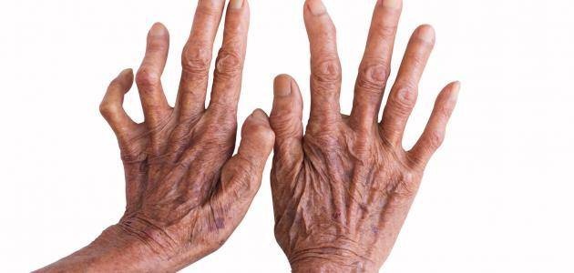 «الجذام» .. مرض يصيب آلاف الأشخاص كل عام