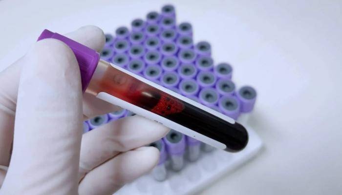 «الخزعة السائلة» ..  أداة جديدة لتتبع حالة مرضى السرطان